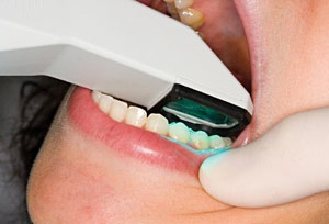 itero-scanning-teeth