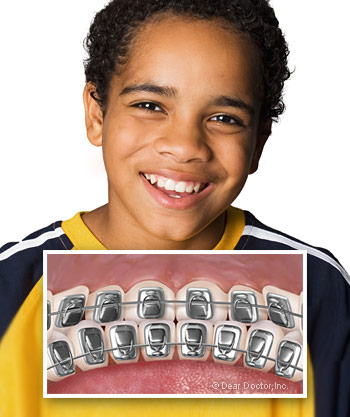 boy-with-lingual-braces