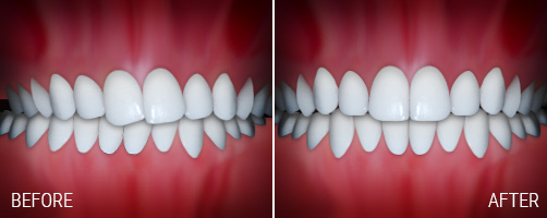 crossbite.jpg