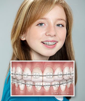 girl-with-ceramic-braces