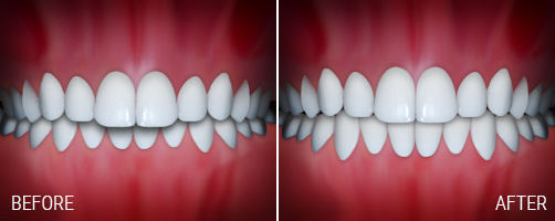 overbite.jpg
