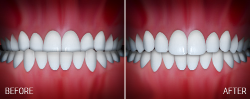 underbite.jpg